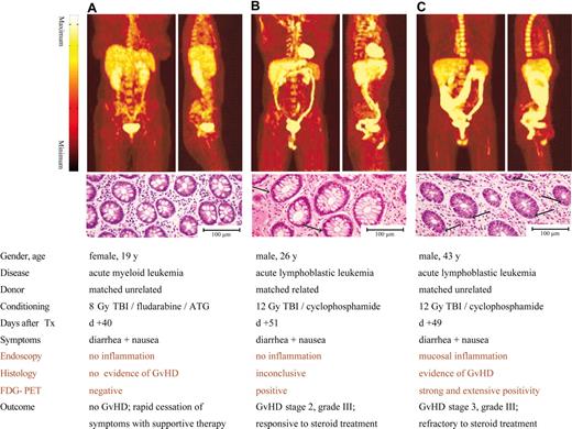 Figure 3. Comparison of FDG-PET images with endoscopic and histopathologic findings in relation to clinical presentation and outcome in patients with suspected intestinal GVHD after allogeneic HSCT. A significant FDG uptake was detected in the colons of patients with clinical signs of GVHD and diagnostic or inconclusive histopathologic findings (B,C). The results are representative of 30 different patients with suspected gastrointestinal GVHD. Arrows indicate apoptotic mucosa cells, compared with physiological findings in a patient with no intestinal GVHD (A).