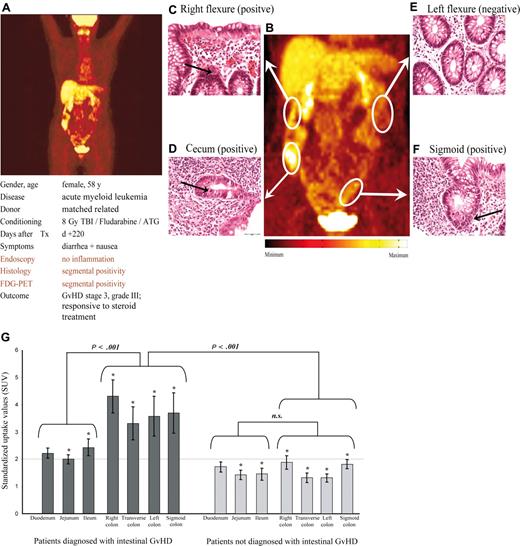 Figure 4. FDG-PET identifies areas of inflammation in a case of segmental manifestations of intestinal GVHD and allows noninvasive monitoring of treatment response. The top panels (A-F) show findings in a representative patient diagnosed with intestinal GVHD. PET images showed segmental inflammation of the right colon (SUV, 5.1) and sigmoid colon (SUV, 2.2), and normal FDG uptake in the transverse (SUV, 1.0) and left (SUV, 1.6) colon segments (A,B). Histopathology of serial biopsies of the whole colon verified GVHD in those segments matching with increased local glucose uptake (C,D,F). Histopathology of colon segments with normal PET findings showed no evidence of GVHD (E). Depicted histologies are representative of at least 3 independent mucosal samples of each colon segment. Arrows indicate examples of apoptotic mucosa cells. (G) SUVs of FDG in 30 patients with (left side) or without (right side) clinical proven intestinal GVHD showed significant differences. Analyses of different intestinal segments in patients without intestinal GVHD showed a mean SUV of less than 2. In contrast, colon segments of patients with intestinal GVHD showed significant higher SUV compared with respective segments of the small gut as well as in comparison with colon segments of patients without intestinal GVHD. Error bars indicate SEM for each segment. *Statistically significant differences for each bowel segment of patients with GVHD compared corresponding segments of patients without GVHD (P < .05).