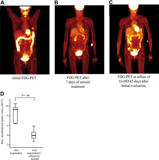 Figure 5. Prognostic assessment and monitoring of therapy response of intestinal GVHD with sequential FDG-PET scans in a patient with late onset acute intestinal GVHD. (A) The initial scan showed a distinct inflammation of the whole colon. At that time, histopathology of mucosal specimens obtained from different colon segments revealed typical features of GVHD. (B) After 7 days of corticosteroid treatment, re-evaluation by FDG-PET showed nearly normal glucose uptake of the colon in line with almost complete clinical response of the GVHD. (C) After 45 days, clinical relapse of intestinal GVHD was associated with reappearance of increased glucose uptake of the initially affected sites of the colon. These individual results are representative of 4 different patients with repeated FDG-PET examinations after treatment of gastrointestinal GVHD. (D) Comparison of maximum initial FDG uptake in segmental analysis of the bowel showed that patients with fast response to immunosuppressive treatment within 1 week (5 patients) had higher maximal FDG uptake than those 9 patients with slowly responding (4 patients) or refractory (5 patients) GVHD (presentation of median, minimum, and maximum SUV with quartiles of each group). ATG indicates antithymocyte globulin.