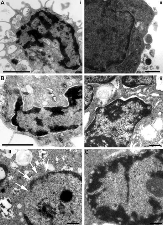 Figure 6. Structural examination of MCs stimulated with either S pyogenes or glucose oxidase by transmission electron microscopy. MCs were incubated with medium alone (A), with S pyogenes for 6 hours (B), or with 100 mU/mL of glucose oxidase (C). Unstimulated MCs show intact nuclear membrane (A), whereas the external and internal sheets of the nuclear membrane start to separate in S pyogenes–stimulated (B) and glucose oxidase–stimulated (C) MCs. Desintegration of the nuclear membrane can be seen in panels Biii (arrows) and C. Bars are 2 μm (Ai,Bi) and 0.5 μm (Aii,Bii,iii,C).