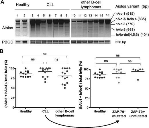 Figure 1. hAio1 is the most abundant Aiolos isoform in normal and malignant B cells. (A) Representative results of Aiolos isoform expression in 2 healthy subjects (1 and 2), 7 CLL (3-9), and 7 other B-cell lymphomas (10-16) patients of the set 1 after one-step RT-PCR amplification of PBMC RNA with the following primers: Aiolos forward 5′-GGCAGCGACATGGAAG-3′ (exon 1), Aiolos reverse 5′-TAGCTGATGGCGTTATTGATGG-3′ (exon 8). Porphobilinogen deaminase (PBGD) is used as internal control with the following primers: PBGD forward 5′-CTGGTAACGGCAATGCGGCT-3′, PBGD reverse 5′-GCAGATGGCTCCGATGGTGA-3′. The vertical line in band Aiolos is the result of a malfunction of the UV machine. (B) Ratio of absolute Aiolos isoform quantities obtained using reverse-transcribed quantitative polymerase chain reaction between primer pair/probe couple 1 (Applied Biosystems, Hs00232635_m1, exons 2-3 junction, hAio1-5 + hAio-del)(4,5,6) and primer pair/probe couple 2 (Applied Biosystems, Hs00918017_m1, exons 5-6 junction, hAio1 + hAio4) of each subgroup of patients and healthy subjects of the set 2 (B cells). Distinct PCR efficiencies between Aiolos TaqMan gene expression assays were corrected by absolute quantifications of known quantities of pcDNA3.1-hAio1 construct. Differences between groups were tested using one-way ANOVA and Tukey multiple comparison tests (Prism4.0c software; ns indicates nonsignificant, ie, P > .05).