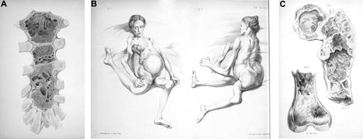 Figure 2. Sarah Newbury, the first reported patient with multiple myeloma. (A) Bone destruction in the sternum. (B) The patient with fractured femurs and right humerus. (C) Bone destruction involving the femur. Adapted from Solly7 with permission.