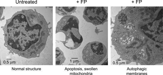 Figure 7. Transmission electron microscopy (TEM) of flavopiridol-treated CLL cells. Peripheral blood from CLL patients was incubated with or without 3.0 μM FP for 6 hours. CD19+ cells were then isolated, fixed, and processed for TEM. Data shown are from 1 representative patient sample of 4 tested.