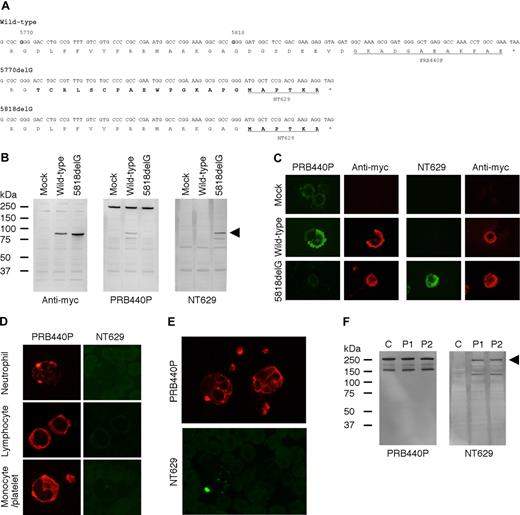 Figure 1. Characterization of NT629 antibody. (A) Site of single nucleotide deletions in MYH9 exon 40 and amino acid sequence of NMMHC-IIA carboxyl-terminal region. Nucleotides encoding amino acids are numbered beginning with initiation codon. Deduced amino acid sequence is written under nucleotide sequence. Deletions of a single guanine nucleotide (bold type) results in frameshift that cause replacement by aberrant amino acids at the carboxyl terminus (bold type) and premature termination. Epitopes of PRB440P and NT629 antibodies are underlined. (B) Total proteins of 293T cells transiently transfected with vectors expressing N-terminal myc-tagged wild-type MYH9 rod (1278-1960 aa) and 5818delG mutant MYH9 rod (1278-1946 aa) were analyzed by immunoblotting. Band corresponding to recombinant myc-tagged NMMHC-IIA rod was detected with antimyc antibody in both wild-type MYH9– and 5818delG MYH9–-transfected cells. PRB440P and NT629 detected recombinant NMMHC-IIA rod only in wild-type MYH9–transfected cells and in 5818delG MYH9–transfected cells (arrow head), respectively. Endogenous 220-kDa NMMHC-IIA band was detected in 293T cells with PRB440P. (C) Immunofluorescence analysis of 293T cells transiently transfected with N-terminal myc-tagged wild-type MYH9 rod and 5818delG MYH9 rod expression vectors double stained with PRB440P and antimyc mouse antibody, and with NT629 and antimyc rabbit antibody, respectively. PRB440P and NT629 intensely stained cytoplasm only in wild-type– and only in 5818delG-transfected cells, respectively. PRB440P weakly stained endogenous NMMHC-IIA in nontransduced 293T cells. (D) Immunofluorescence analysis of peripheral blood smears from a patient with E1841K double stained with PRB440P and NT629. PRB440P showed abnormal type I NMMHC-IIA localization in all neutrophils with diffusely stained background, and diffuse cytoplasmic staining in lymphocytes, monocytes, and platelets. In contrast, cells were not stained with NT629 antibody. (E) Immunofluorescence analysis of peripheral blood smears from a mosaic patient for 5818delG double-stained with PRB440P and NT629. PRB440P showed abnormal type I NMMHC-IIA localization in approximately 10% neutrophils, in which inclusion bodies were stained with NT629. Normal neutrophils with diffuse NMMHC-IIA distribution were not stained with NT629. (F) Immunoblots of buffy coat samples from healthy control and from patients 1 (5770delG) and 2 (5818delG). NT629 detected band corresponding to NMMHC-IIA polypeptide and additional small band in blood from patients, but not control.