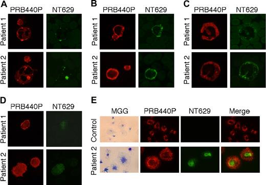 Figure 3. Differential expression of mutant NMMHC-IIA polypeptide in peripheral blood cells. Immunofluorescence analysis of peripheral blood smears from patients 1 and 2 double stained with PRB440P (red) and NT629 (green). (A) PRB440P stained granular NMMHC-IIA accumulation and diffusely stained cytoplasm of neutrophils, whereas NT629 stained only intense cytoplasmic foci and no background. (B) Lymphocytes were diffusely stained with both PRB440P and NT629. (C) In monocytes, both PRB440P and NT629 detected small dots in addition to diffuse cytoplasmic staining. Platelets in panels A-B are notably not stained with NT629. (D) PRB440P diffusely stained platelet cytoplasm and intensely stained cell periphery. In contrast, most platelets are NT629 negative; only extraordinarily large platelets are diffusely stained. (E) Mutant NMMHC-IIA polypeptide cannot translocate to lamellipodia in surface-activated platelets. Platelets were adhered to glass slides for 10 minutes, fixed, and processed for PRB440P and NT629 immunofluorescence analysis. Left column: images stained with May-Grünwald-Giemsa. Mutant NMMHC-IIA was weakly distributed only in granulomere zone of platelets from patients. Platelets from patients 2, 3, and 4 were examined. Original magnification, ×1000.