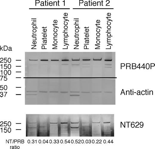 Figure 4. Mutant NMMHC-IIA polypeptide is present in leukocytes but decreased in platelets. Immunoblot analysis of isolated neutrophils, platelets, monocytes, and lymphocytes from patients 1 and 2. Whole cell proteins were separated by SDS-PAGE and resolved proteins were electroblotted onto polyvinylidine difluoride membranes. Blots were cut horizontally in half at approximate position of 75-kDa molecular marker. The top half of each blot was probed with PRB440P or NT629; bottom portions were reacted with antiactin antibody. A horizontal line has been inserted to indicate where the gel was cut. Top panels show blots probed with PRB440P and antiactin antibody. Bottom panel shows blots probed with NT629. Analysis with NT629, which recognizes only mutant NMMHC-IIA polypeptide, revealed mutant NMMHC-IIA expression in neutrophils, lymphocytes, and monocytes but obviously decreased expression in platelets. Signal ratio of NT629 to PRB440P is also obviously decreased in platelets compared with leukocytes.