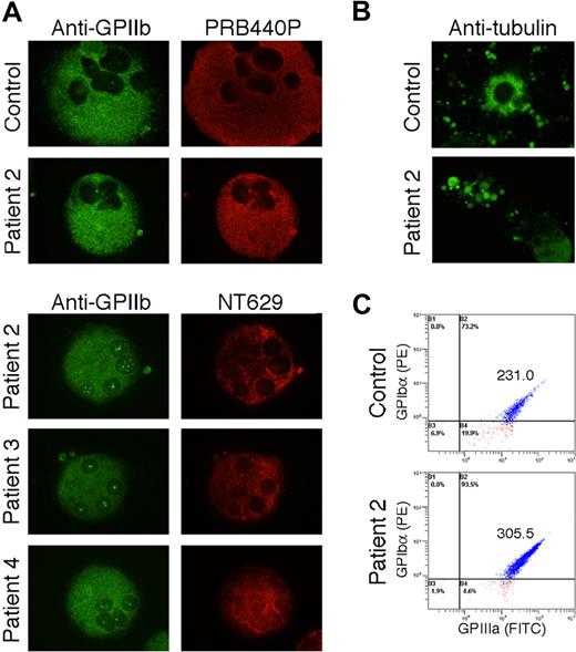 Figure 5. NMMHC-IIA localization in megakaryocytes derived from peripheral blood CD34+ cells. (A) Megakaryocytes derived from peripheral blood CD34+ cells of healthy controls and patients were double-stained with anti-GPIIb mouse monoclonal antibody SZ22 (green) and PRB440P (red, top panels) or with anti-GPIIb rabbit polyclonal antibody (green) and NT629 (red, bottom panels). PRB440P diffusely stained cytoplasm of megakaryocytes from control and patients, whereas NT629 coarsely and heterogeneously stained those of patients. (B) Megakaryocytes that produce platelets. Original magnification, ×1000. (C) Flow cytometric analysis of plateletlike particles double stained with anti-GPIbα and anti-GPIIIa antibodies. Geometric mean of forward scatter of GPIbα and GPIIIa double-positive cells was shown in inset.
