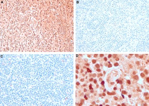 Figure 5. Osteopontin immunohistochemistry in DLBCL. The immunoperoxidase complexes were visualized with diaminobenzidine (brown), and the sections were counterstained with hematoxylin. (A) PCNSL: original magnification ×200. Nearly every tumor cell of this brain biopsy is immunoreactive. (B) Nodal DLBCL: original magnification ×200. Essentially no tumor cell contains immunoreactivity. (C) Extranodal DLBCL (skin): original magnification ×200. Essentially no tumor cell contains immunoreactivity. (D) PCNSL: original magnification ×1000 oil. Cross section of a small vessel, probably a vein, surrounded by osteopontin-positive tumor cells.