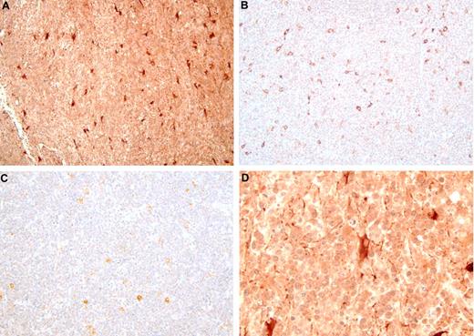 Figure 6. Chitinase-3-like 1 immunohistochemistry in DLBCL. The immunoperoxidase complexes were visualized with diaminobenzidine (brown), and the sections were counterstained with hematoxylin. (A) PCNSL: original magnification ×200. Most tumor cells express moderate levels of CHI3L1 with a minority expressing strong levels. The largest profiles with heavy immunoreactivity are possibly astrocytes (see also panel D). (B) Nodal DLBCL: original magnification ×200. Most of the tumor cells contain low levels of immunoreactivity. The larger, strongly positive cells may be macrophages. (C) Extranodal DLBCL (spleen): original magnification ×200. (D) PCNSL: original magnification ×400. This is a higher power view of the PCNSL shown in panel A, showing astrocyte-like profiles with moderate to strong levels of immunoreactivity.