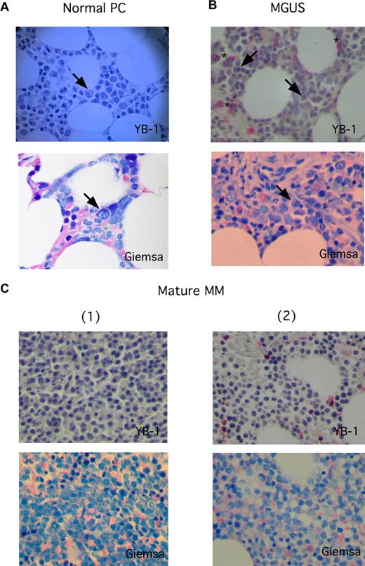 Figure 1. YB-1 expression is lacking in situ in normal PCs, in PCs of patients with MGUS, and in MM cells with a mature PC morphology. (A-C) Immunohistochemical analyses of YB-1 protein expression in situ, (A) in normal PCs of the BM, (B) in premalignant PCs from a patient with MGUS, or (C) malignant PCs with a mature phenotype from 2 patients with MM. PC morphology was highlighted by staining according to Giemsa. A normal PC (marked by an arrow in panel A), PCs from patients with MGUS (marked by arrows in panel B), and morphologically mature-appearing MM cells (C) do not express YB-1, which seems to be, however, sometimes expressed in granulopoietic cells (*). Images were acquired as described in “Immunohistochemical analysis.”