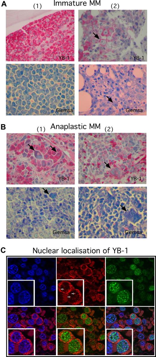 Figure 2. YB-1 is strongly expressed in situ in MM cells with immature and anaplastic morphology. (A,B) Immunohistochemical analysis of YB-1 protein expression in situ, or (A) in morphologically immature or (B) anaplastic PCs. Biopsies shown in panel A were obtained from the BM of 2 patients with MM; biopsies in panel B were obtained from different extramedullary sites of 2 patients with MM. Strong, diffuse predominantly cytoplasmatic expression of YB-1 is observed in morphologically immature MM cells (A) and in morphologically anaplastic MM cells (B). Each patient panel includes a Giemsa stain to highlight PC morphology. Arrows in panel A indicate a prominent nucleolus, which is a typical feature of immaturity. Arrows in panel B indicate large, multinucleated, bizarrely formed PCs, which are characteristic of an anaplastic phenotype. (C) Immunofluorescence images of primary MM samples stained for YB-1 (Cy3; red), IRF4 (Cy5; green) and nuclei (DAPI; blue). YB-1 is in situ detectable in the cytoplasm and nuclei of MM cells and is organized in dot-like structures (white arrows) inside the nucleus. Nuclear YB-1 is colocalized with transcriptionally active euchromatin (weak DAPI staining). Staining of IRF4 was performed to mark PCs. The insets show details of the picture in a 2-fold magnification. Images in panels A and B were acquired as described in “Immunohistochemical analysis,” and in panel C as in “Confocal microscopy.”