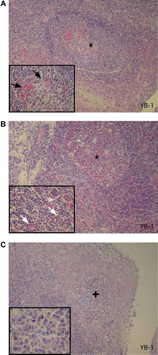 Figure 3. YB-1 is expressed in germinal center B cells but not in mature PCs in activated tonsils. (A-C) Immunohistochemical analysis of YB-1 protein expression in situ in antigen-activated tonsils as secondary lymphoid organs. (A) Centroblasts in the germinal center (*) of the secondary follicle show a strong YB-1 expression (red). The integrated inset in the lower left corner shows a 2-fold magnification of the germinal center with YB-1–expressing centroblasts as indicated by black arrows. (B) Activated extrafollicular B-cell blasts also display expression of YB-1 protein as shown in higher magnification (2-fold) in the inset by white arrows. The gray arrowhead marked the single mature PC that is YB-1−. (C) A subepithelial PC accumulation (+) of the same tonsil PCs with a mature PC morphology (inset with a 3-fold magnification) that display no YB-1 expression. Images were acquired as described in “Immunohistochemical analysis.”