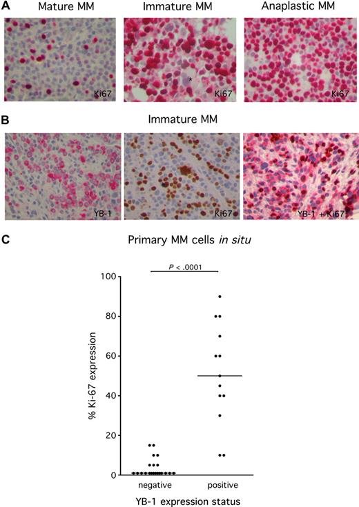 Figure 4. High frequency of expression of the proliferation marker Ki 67 in YB-1+ MM cells. (A) Immunohistochemical analysis of Ki 67 protein expression in situ in YB-1−, mature MM cells (left), or YB-1+, immature MM cells (center) or anaplastic MM cells (right). *Negatively stained megakaryocyte. (B) Immunohistochemical analysis staining either of YB-1 (red; left) or Ki 67 protein (brown; center) or both (red and brown; right) in YB-1+, immature MM cells. Images were acquired as described in “Immunohistochemical analysis.” (C) Ki 67+ MM cells were counted to determine the growth fraction. Expression of Ki 67 is significantly more frequent in YB-1+, morphologically immature, or anaplastic PCs than in YB-1−, morphologically mature PCs. Also shown is the median of the percentage of Ki 67 staining in MM samples.