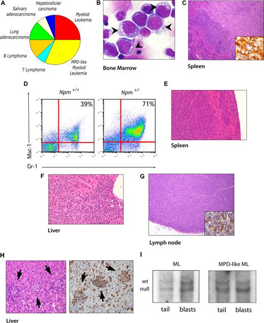 Figure 1. Features of Npm1+/− mice hematologic malignancies. (A) Pie chart showing tumor spectrum in Npm1+/− mice. (B) Bone marrow cytospin (60×/0.80 NA oil objective magnification) from an ML Npm1+/− mouse showing blasts with intracytoplasmic vacuoles, high nuclear/cytoplasmic ratio, basophilic cytoplasm, and multiple nucleoli (arrowheads). (C) Spleen section (10×/0.30 NA oil objective magnification) from the same mouse showing mass involving the red pulp composed of atypical mononuclear cells. The inset is a 40×/0.75 NA oil objective magnification of the immunohistochemical staining for muramidase indicating blasts originating from the myeloid lineage. (D) Flow cytometry analysis of bone marrow from an MPD-like ML Npm1+/− mouse demonstrates an expansion of Gr-1/Mac-1 mature cells. Numbers on graphs are percentages of cells in total bone marrow. (E) Spleen section (10×/0.30 NA oil objective magnification) from the same mouse in panel D showing both red and white pulp replaced by atypical mononuclear infiltrate. (F) Liver section (40×/0.75 NA oil objective magnification) from the same mouse in panel D showing infiltration of periportal area extended into the parenchyma as well. (G) Lymph node (10×/0.30 NA oil objective magnification) replacement by atypical lymphoid infiltrate of CD45R+ cells (inset 40×/0.75 NA oil objective) supporting the involvement of a B-cell lymphoma. (H) Hematoxylin and eosin staining of liver lobular infiltrates (40×/0.75 NA oil objective magnification, arrows in left panel). Immunohistochemistry shows lobular lymphoid infiltrates in liver positive for CD3 (arrows in right panel). (I) Southern blot analysis on tail and blast DNA from representative ML (left panel) and MPD-like ML (right panel) affected Npm1+/− mice.