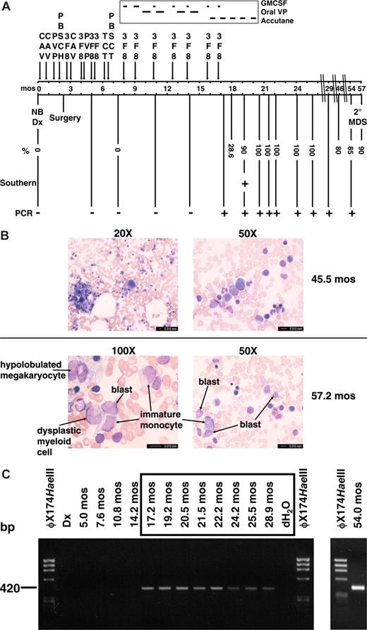 Figure 1. Summary of therapy, clinical course, and cytogenetic and molecular analyses of sequential marrows. (A) Timeline with scale in months (mos) from neuroblastoma diagnosis. Percentages indicate maximum abnormal marrow cells by karyotype, FISH with dual color probe for MLL (Vysis, Downers Grove, IL), or chromosome 4 and 11 painting probes (Vysis). Abbreviations: CAV, cyclophosphamide (2100 mg/m2 per day × 2), doxorubicin (25 mg/m2 per day × 3), vincristine (0.66 mg/m2 per day × 3); PVP, cisplatin (50 mg/m2 per day × 4), etoposide (200 mg/m2 per day × 3); PBSCH, autologous peripheral blood stem cell harvest; 3F8, anti-GD2 antibodies; TCT, thiotepa (300 mg/m2 per day × 3), carboplatin (500 mg/m2 per day × 3), topotecan (2 mg/m2 per day × 5); PBSCT, autologous peripheral blood stem cell transplant; GMCSF, granulocyte macrophage colony stimulating factor; oral VP, oral etoposide (50 mg/m2 per day × 21 days). (B) Representative bone marrow aspirate smear from 45.5 months after neuroblastoma diagnosis at low-power magnification showing normal morphology and trilinear hematopoiesis (top left), and higher power magnification of normal erythroid and myeloid cells in same bone marrow aspirate (top right). Representative bone marrow aspirate smear from 57.2 months after neuroblastoma diagnosis at high-power magnification showing blasts, immature monocytes, a hypolobulated megakaryocyte, and a dysplastic myeloid cell (bottom left and right). Bone marrow aspirates were visualized using a Leica DMLB microscope (20×/0.40 aperature; 50×/0.90 aperature; 100×/1.25 aperature) captured with a Leica DFC420 camera (imaging medium of air for 20×, immersion oil for 50× and 100×), acquired using Leica Application Suite and processed using Microsoft (Redmond, WA) PowerPoint. (C) Tracing of der(11) genomic breakpoint junction in sequential marrows. The clonotypic der(11) genomic breakpoint junction was detectable by PCR in sample from 17 months after neuroblastoma diagnosis and all specimens thereafter. Time represents months from neuroblastoma diagnosis. All positive samples were sequenced to verify the breakpoint junction.