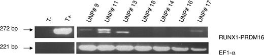 Figure 1. Ethidium bromide–stained gel showing expression of RUNX1-PRDM16 fusion transcript (upper RT-PCR product of 272 bp, confirmed by sequencing analysis) for 3 of 7 analyzed patients (UPNs 9, 11, and 17). Sequencing data after purification of the lower band revealed unspecific RT-PCR products (UPN 11 and UPN 13). The EF1α RT-PCR product (221 bp) was used as the endogenous control.