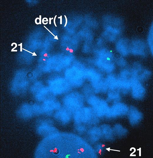Figure 2. FISH analysis of UPN 17 using the TEL/AML1 dual-color, dual-fusion translocation probe. Three RUNX1/AML1 signals are observed in red, on 2 normal chromosomes 21 and on the derivative chromosome 1. The residual signal RUNX1/AML1 on the derivative chromosome 21 is lost. The green signal corresponds to the TEL locus 12p12 and the loss of the second green signal confirms the del(12)(p11;p13) observed on karyotyping analysis. Image was acquired with a Leica DMXRA microscope (Leica, Wetzlar, Germany) fitted with a 100×/1.30 numeric aperture oil objective, a Photometrics Sensys CCD camera (Roper Scientific, Tucson, AZ) and QFISH image acquisition software (Leica).