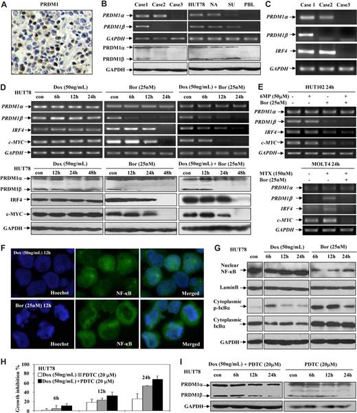Figure 1. PRDM1 was expressed in T-cell lymphoma and could be down-regulated by bortezomib through NF-κB inactivation. (A) Nuclear PRDM1 protein expression was revealed by immunohistochemistry on lymphoma tissue. Leica AS LMD (Leica Microsystems), 40×/0.6 CORR XT, air/0.6, hematoxylin-eosin stain, Video camera 3CCD Hitachi HV-Dz0P, Leica AS LMD software, version 4.4. (B) PRDM1 mRNA and protein expression were detected by semiquantitative PCR on lymphoma cells and Western blot on lymphoma tissue, respectively. PRDM1 isoforms were expressed in laser-microdissected lymphoma cells and T- and B-lymphoma cell lines (NA indicates namalwa; SU, SU-DHL-4), but not in peripheral blood lymphocytes (PBLs). (C) Laser-microdissected lymphoma cells showed coexpression of PRDM1 and IRF4. (D) In HUT78 cells resistant to doxorubicin (Dox), PRDM1β, IRF4, and c-MYC expression was reduced by bortezomib (Bor) both at transcriptional (top panel) and protein (bottom panel) level. (E) In HUT102 cells resistant to 6-mercaptopurine (6MP, 50 μM), PRDM1β, IRF4, and c-MYC expression was also reduced by bortezomib (Bor, 25 nM) (top panel). In MOLT4 cells, when methotrexate resistance was developed (MTX, 150 nM), PRDM1β was expressed, and subsequently reduced by bortezomib (Bor, 25 nM) (bottom panel). (F) Immunofluorescence study revealed that NF-κB (P65) was located mainly in nucleus in doxorubicin (Dox)–treated HUT78 cells, while in cytoplasm in those treated with bortezomib (Bor). Leica AS LMD, 100×/1.3 oil, oil/1.3, Immunofluorescent stain, Video camera 3CCD Hitachi HV-Dz0P (Hitachi, Tokyo, Japan), Leica AS LMD software, version 4.4. (G) Bortezomib (Bor) blocked NF-κB nuclear translocation and retained the phosphorylated form of IκBα (p-IκBα) and IκBα in the cytoplasm of HUT78 cells. Lamin B was used as a nuclear protein control. (H and I) Addition of NF-κB inhibitor PDTC increased the antiproliferative effect of doxorubicin (Dox) on HUT78 cells (H) and induced PRDM1β down-regulation (I).