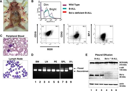 Figure 2. Development of B-ALL–like disease in the absence of Bcl-xL. (A) Macroscopic phenotype of Bcl-x–deficient B-ALL mouse 17 days after induction. Enlarged lymph nodes are denoted by black arrows and spleen by the yellow arrow. (B) Top panel: lymphoblasts from diseased mice are B220dim. Bone marrow cells were isolated from wild-type (purple), B-ALL (green), and Bcl-x–deficient B-ALL (red) and stained for expression of B220. Bottom panels: lymphoblasts from Bcl-x–deficient B-ALL mice are arrested at a pre–B-cell stage of development. Bone marrow cells stained for coexpression of B220 and CD19, CD43, and BP-1. (C) Wright-Giemsa staining of peripheral blood (PB; top panel) 14 days after induction and lymph node (LN) cells (bottom panel). Mitotic figures are denoted by black arrows. (D) DNA isolated from tissues of tissues from Bcl-x–deficient B-ALL mice was subjected to 3-primer PCR to determine efficiency of recombination of Bcl-x f/f alleles. DNA was isolated from bone marrow (BM; lanes 1 and 2), lymph node (LN; lanes 3 and 4), pleural effusion (PE; lanes 5 and 6), and spleen (SPL; lanes 7 and 8). Arrows indicate floxed and recombined alleles. Lane 9 represents no recombination. Vertical bars indicate repositioned lanes. (E) Result of Western blot analysis from pleural effusion of B-ALL (lanes 1-3) and Bcl-x–deficient B-ALL (lanes 4-6) mice. Lysates were immunoblotted against c-abl– (loading control, also recognizes BCR/ABL oncoproteins), Bcl-x–, and actin-specific antibodies.