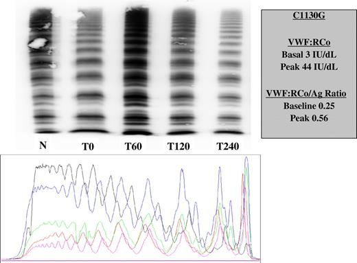Figure 1. Multimeric pattern (medium resolution gel) of plasma VWF and densitometric scan of multimeric profile before and after desmopressin in a patient with C1130G mutation. Black = normal plasma; red = time 0; blue = time 60 minutes; green = time 120 minutes; and magenta = time 240 minutes. All the multimers are present, although the largest are relatively decreased (red), with increased smaller multimer concentrations. After desmopressin, an increase of the largest forms but also of the smaller forms is observed, with progressive return to basal pattern (increased clearance).