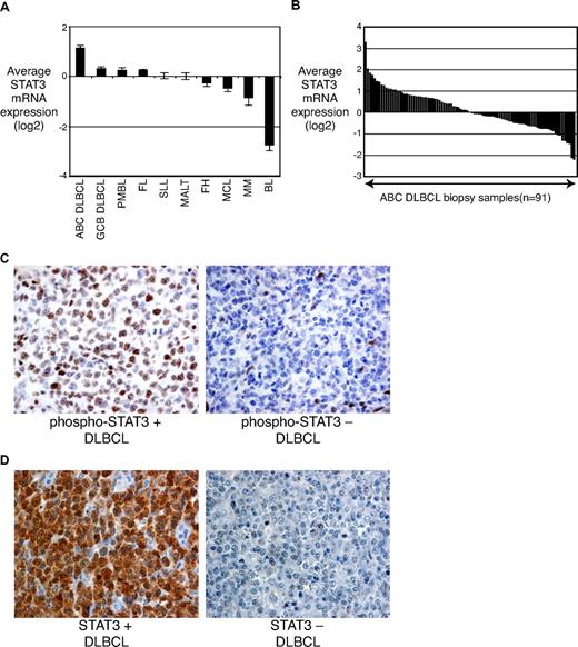 Figure 3. STAT3 expression in primary lymphoma tumors. (A) Mean STAT3 mRNA levels in tumor samples as assessed by gene-expression profiling. PMBL, primary mediastinal B-cell lymphoma; FL, follicular lymphoma; SLL, small lymphocytic lymphoma; MALT, mucosa-associated lymphoid tissue; FH, follicular hyperplasia; MCL, mantle cell lymphoma; MM, multiple myeloma; BL, Burkitt lymphoma. (B) Histogram of STAT3 mRNA levels in individual ABC DLBCL tumor biopsies. (C) Immunostaining with a p-STAT3 (Tyr705)–specific antibody showing dense brown staining in ABC DLBCL cases. (D) Immunostaining with an antibody recognizing total STAT3 showing dense brown staining in STAT3-high ABC DLBCL cases.