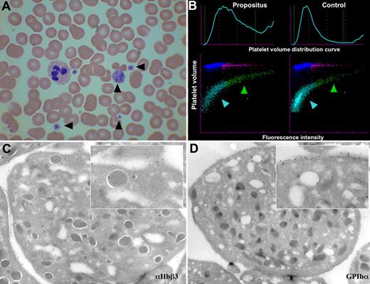 Figure 2. Images of the blood and platelets of the propositus. (A) Light microscopy (×50) of a blood smear with Romanovski stain; platelets are indicated by arrowheads. (B) Flow cytometric scatter plot analysis of platelet RNA content of propositus and control (mean volume as forward scatter and RNA content as fluorescence intensity). The immature platelet fraction is indicated by a green arrowhead, and the mature fraction is indicated by a blue arrowhead. (C,D) Electron micrographs of the propositus's platelets with immunogold staining for αIIbβ3 (C) and GPIb-IX-V (D). Inserts are a ×7 amplification.