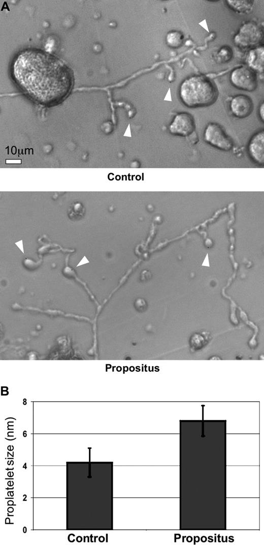 Figure 5. Abnormal proplatelet formation in B3 D723H megakaryocytes. (A) Light phase-contrast microscopy of propositus and control MKs derived from peripheral blood CD34+ stem cells cultured in serum-free medium for 10 days. Arrowheads point to the proplatelet swellings and the bulbous tips. Scale bar equals 10 μm. (B) Quantification of the average diameter of the proplatelet swellings from propositus (n = 15) and control (n = 30). Bars represent the mean plus or minus SD.