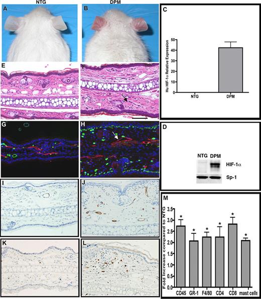 Figure 1. “Inflammatory priming” by epithelial mediated stromal inflammatory cell recruitment in K14-HIF-1αDPM transgenic mice. Redness and prominent vasculature of ear skin in transgenic mice (DPM) (B), which are not evident in nontransgenic mice (NTG) (A). Human HIF-1α mRNA (C) and total (human and potentially mouse) HIF-1α protein (D) are detectable only in transgenic ears. Ear histology reveals increased dermal cellularity in transgenic mice (F, arrows), compared with nontransgenic mice (E). Differential increase in subepidermal microvessels, revealed by MECA-32 immunohistochemistry (green), and lymphatic dilatation, LYVE-1 antibody (red, see white arrow) in DPM transgenic mice (H) versus nontransgenic controls (G). Endothelial activation evidenced by ICAM-1 immunohistochemistry, in transgenic (J), versus nontransgenic (I) ears. Increased number of CD45.1 positive inflammatory cells in transgenic (L) versus nontransgenic (K) ears. A 2- to 3-fold increase of neutrophils, mast cells, macrophages, and lymphocytes, determined by differential immunohistochemical analysis of inflammatory markers as indicated in panel M. Bar in panel F represents 100 μm.