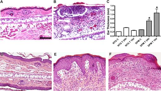 Figure 2. Transgenic mice exhibit enhanced and prolonged response to an inflammatory challenge. Intraepidermal neutrophilic abscesses 6 hours after TPA challenge in transgenic mice (B) compared with low-level dermal inflammatory cell infiltrate in nontransgenic controls (A). Persistent ear swelling 10 days after TPA challenge evidenced by caliper ear thickness in transgenic (DPM) versus control (NTG) ears (C). Histologic resolution of inflammation in nontransgenic ears 10 days after TPA challenge (D). In contrast, transgenic ears (E,F) evidence psoriatic-type changes of increased epidermal thickness, epidermal rete ridge dermal projections, subepidermal edema, and foci of parakeratosis (F). Bar in panel A represents 100 μm.