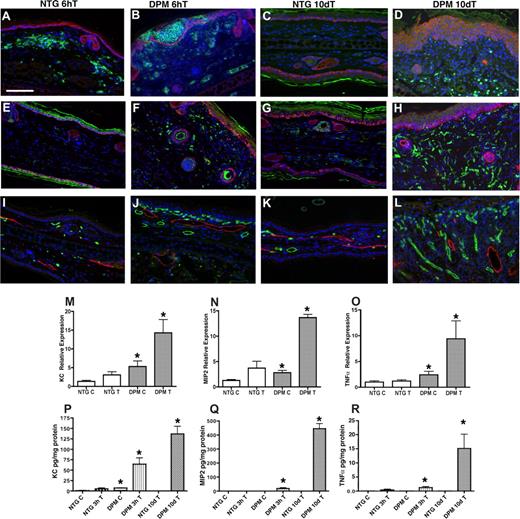 Figure 4. K14-HIF-1αDPM mice exhibit epidermal and dermal inflammatory infiltrates accompanied by hyperplastic cutaneous blood vessels and lymphovascular dilation. Increase of GR1+ neutrophils in green (A-D) and F4/80+ macrophages in green (E-H) 6 hours (B,F) and 10 days after TPA challenge (D,H) in transgenic ears (DPM) compared with nontransgenic littermates (NTG) (A, E, C, and G, respectively). Counterstaining with a keratin-14 antibody (red) highlights the differential persistent increase in epidermal thickness in transgenic mice. Progressive increase in microvascular density (MECA32, green) along with lymphovascular dilatation (LYVE-1, red) is observed between the 6-hour and 10-day after TPA time intervals in transgenic ears (J,L) compared with nontransgenic littermates (I,K). Bar in panel A represents 100 μm. Real-time TaqMan RT-PCR analysis of keratinocyte chemokine (KC) (M), macrophage inflammatory protein-2 (MIP-2) (N), and TNFα (O) expression from total RNA isolated from ears of transgenic and nontransgenic controls, using histone 3.3A as a reference, at baseline and 1 hour after TPA treatment. KC (P), MIP-2 (Q), and TNFα. (R) ELISA assays reveal significantly higher protein expression in the inflamed ears of transgenic mice after 3 hours and 10 days after a single TPA application. Error bars represent mean plus or minus SEM of 4 to 6 mice analyzed per group (*P < .05).