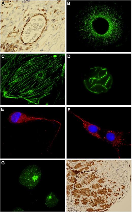 Figure 1. CLL mAbs bind to autoantigens. (A) I83/IGHV3-30UM IgM binding to lymph node (tonsil) thin paraffin section visualized by immunohistochemical staining. (B) I83 mAb binding to FM55M2 melanoma cells. (C) I83 mAb binding to rat aortic smooth muscle cells. (D) I83 mAb binding to Jurkat T cells. (E) HG3/IGHV1-2UM IgM binding to HepG2 cells. (F) Wa/IGHV3-30.3UM/subset-32 IgM binding to HepG2 cells. (G) AIII/IGHV4-59M IgM binding to Jurkat T cells. (H) rIGHV3-21M/subset-2 IgM binding to stomach chief cells. Secondary Ab for immunohistochemical staining was anti–IgM-biotin followed by streptavidin-HRP. Secondary Ab for immunofluorescence was anti–IgM-FITC or anti–IgM-Alexa594.