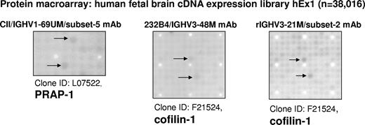 Figure 5. Three CLL mAb-binding patterns in protein macroarray of human fetal brain recombinant proteins (n = 38 016). Digital images from protein macroarray performed on CII/IGHV1-69UM/subset-5 mAb, 232B4/IGHV3-48M mAb, and rIGHV3-21M/subset-2 mAb. The membranes were incubated with CLL mAbs overnight at + 4°C followed by anti–human IgM/A/G-HRP secondary Ab using Lumiphos substrate for development. The E coli–expressed human fetal brain proteins are positioned in duplicates in specific patterns. Arrows show examples of duplicate positive reactions. Secondary Ab reactivities, nonduplicate, and low-avidity bindings were excluded.