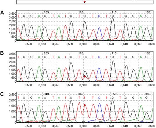 Figure 1. Example of JAK2 V617F mutation as detected in peripheral blood cells and plasma. Wild-type normal control is shown in (A). In trace B the analysis of the peripheral blood cells shows the mutated peak (T) as heterozygous while in plasma sample from the same patient obtained at the same time (trace C) the mutant peak is clearly homozygous/hemizygous.