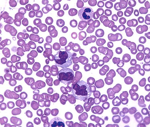 A 59-year-old man was told that he had leukemia that would not be treated. He asked for another opinion. Over the previous 6 months, he had experienced mild weakness, occasional fever, and slight weight loss. He had no other medical problems, and the family history was noncontributory. Examination showed slight pallor and a palpable spleen tip. The patient's hemoglobin count was 112 g/L; white blood cell count, 24×109/L; and platelet count, slightly low. Both hematology specialists who examined the man diagnosed chronic myelomonocytic leukemia. The peripheral blood smear shown above supported this diagnosis by revealing increased monocytes and a pseudo–Pelger-Huet cell. / Essential to this diagnosis is the exclusion of other disorders that are associated with monocytosis, some of which are curable or highly treatable. At city hospitals in the mid-20th century, monocytosis was most often caused by chronic infections such as tuberculosis, pneumonia, and subacute bacterial endocarditis. Other causes of monocytosis include chronic inflammation, underlying malignancies, autoimmune diseases, parasites, postsplenectomy states, and other marrow disorders. / To the patient's dismay, the second consultant agreed with the recommendation for no specific treatment. Although newer drugs are available for this type of myelodysplastic/myeloproliferative process, watch-and-wait management is often appropriate, especially in subjects with few symptoms and no transfusion requirements.