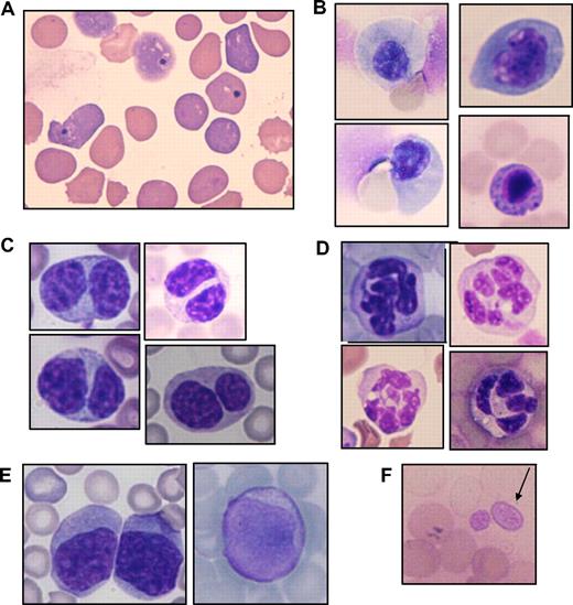 Figure 4. Multilineage dysplasia of hematopoietic cells in mice that received transplants of AML1 mutants. Giemsa-stained PB smears obtained from mice/D171N or S291fs are shown. (A) Howell-Jolly body, polychromasia, and anisopoikilocytosis. (B) Orthochromatic giant erythroblast, karyorrhexis, and nuclear fragments. (C) Pseudo-Pelger-Huet anomaly. (D) Hypersegmented neutrophil. (E) Blasts in peripheral blood. (F) Giant platelet. Images were obtained with a BH51 microscope and DP12 camera (Olympus, Tokyo, Japan); objective lens, UPlanFl (Olympus); magnification, ×1000.