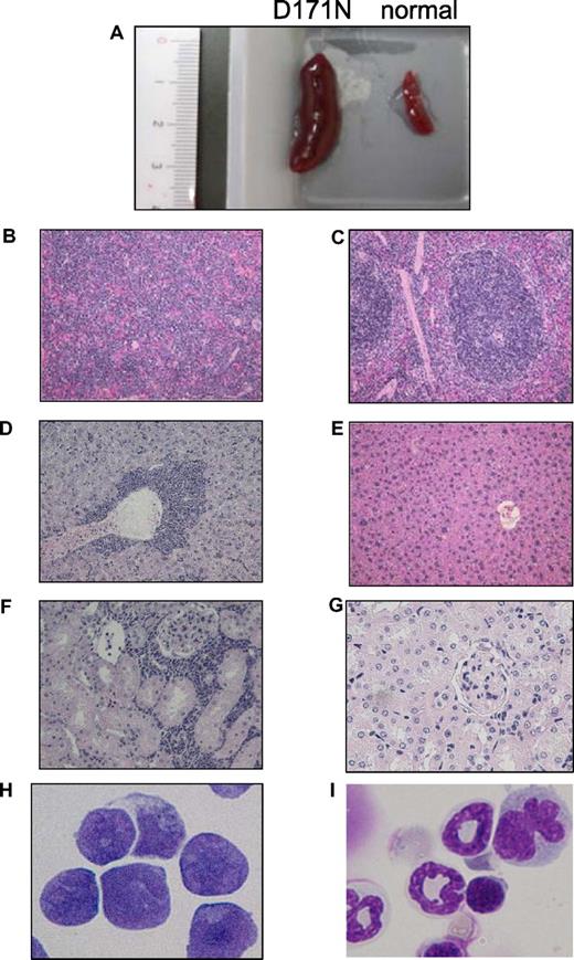 Figure 6. Leukemic cells of mice/D171N with high expression of Evi1 invaded into liver and kidney. (A) Spleen from morbid mice/D171N (left) and from normal mice (right). Histopathologic findings of (B) spleen, (D) liver, and (F) kidney infiltrated with leukemic cells from mice/D171N, stained with H&E. Histopathologic findings of (C) spleen, (E) liver, and (G) kidney from normal mice, stained with H&E. (H) Mice/D171N showed a high percentage of blasts in bone marrow. Cytospin preparations of BM cells from (H) mice/D171N and (I) normal mice, stained with Giemsa. (BX51 microscope, DP12 camera module; objective lens, UPlanFl; magnification, ×200 (B-E); ×100 (F,G); and ×1000 (H,I).