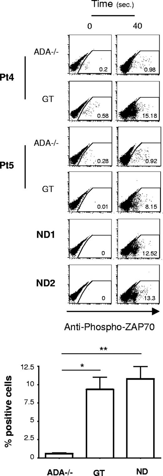 Figure 3. Defective proximal TCR signaling in ADA-deficient T cells. Intracytoplasmic analysis of phosphorylated ZAP-70 (Y319) in response to cross-linked (1 μg/mL), anti-CD3 plus (10 μg/mL), anti–CD28-mediated activation of CD4+ T cells. Dot plots from 2 ADA-SCID patients, before and after GT, and 2 NDs are reported. Results corresponding to frequency of positive cells after 40 seconds of stimulation, in one of 3 independent determinations, from 5 patients and 4 NDs are indicated in the graph. Values corresponding to basal phosphorylation were subtracted (*P < .05; **P < .01).