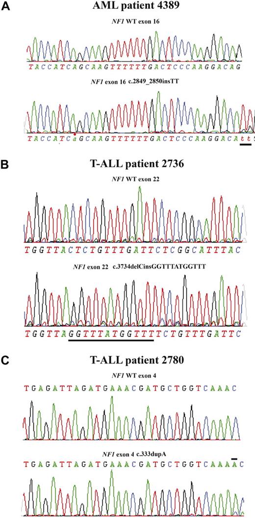 Figure 3. Truncating NF1 mutations in pediatric T-ALL and AML. (A) Sequence analysis of patient no. 4389 (AML) showing a c.2849_2850insTT mutation in the remaining NF1 allele. (B) Sequence analysis of patient no. 2736 (T-ALL) showing a c.3734delCinsGGTTTATGGTTT mutation in the remaining NF1 allele. (C) Sequence analysis of patient no. 2780 (T-ALL) showing a c.333dupA mutation in the remaining NF1 allele.