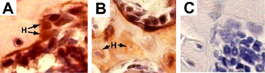 Figure 1. Nonadherent donor bone marrow cells engraft as osteoblasts and osteocytes after transplantation. (A) Representative photomicrograph of a bone/bone marrow section taken from a mouse after nonadherent marrow cell transplantation double stained with anti-GFP (black) and antiosteocalcin (red) antibodies. Several double-positive donor osteoblasts are distributed along the surface of endosteal bone, with a donor (GFP+) osteocyte embedded in bone. Osteocalcin-expressing host cells (H; red stain without GFP) are indicated by arrows. (B) Bone/bone marrow section double stained with anti-GFP (black) and anti-collagen l (red) antibodies. Donor osteoblasts and osteocytes were detected by red/black colocalization. Collagen-expressing host osteocytes (H) are indicated by arrows. (C) Control bone section from a mouse transplanted with nontransduced nonadherent bone marrow cells and stained with anti-GFP and isotype control antibodies. Original magnification for all panels, 1600× (400× optical, 4× digital).