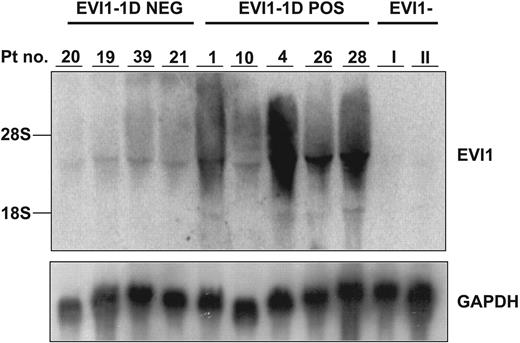 Figure 2. EVI1 mRNA expression levels in EVI1-1D+ and EVI1-1D− AML samples in cohort A and B determined by Northern blot. Human 600-bp EVI1 probe and as control a murine GAPDH fragment were used. Patients I and II represent AML samples without EVI1 expression. The patient numbers correspond to those in Table 1.