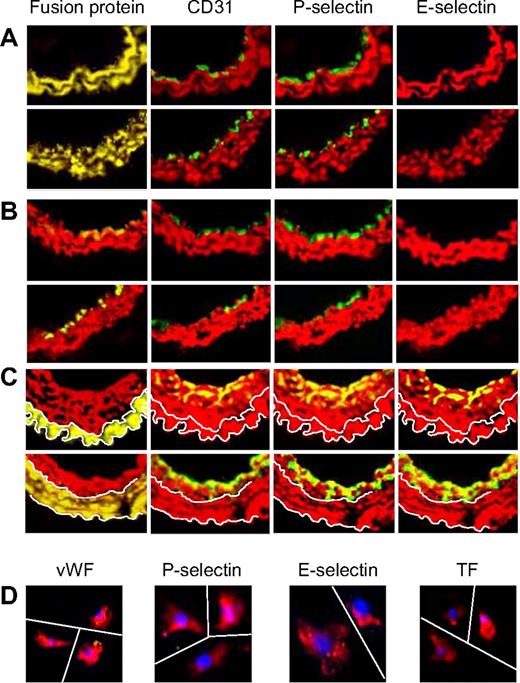 Figure 6. Phenotype of neointimal cells affected by fusion proteins. 2-color immunohistologic analysis of carotid artery sections from α-TFPI–Tg or α-Hir–Tg mice (A), WT mice reconstituted with BM from α-TFPI–Tg or α-Hir–Tg (B) mice, or α-TFPI–Tg or α-Hir–Tg (C) mice reconstituted with BM from WT mice, all taken on day 28 after injury. Consecutive sections were stained with anti–α-SMA (red) and either antifusion protein, anti-CD31, anti–P-selectin, or anti–E-selectin (green). Yellow indicates colocalization. Original images taken at ×100 magnification. White lines in panel C trace out the boundaries of medial fusion protein staining; the same lines have been superimposed on the other images to indicate the boundary between medial and neointimal α-SMA staining. Representative images from experiments performed more than 3 times. (D) 3-color immunohistologic analysis of single cells isolated from intima of α-TFPI–Tg (bottom row) mice. Cells were prepared after first scraping off and discarding the luminal layer. All sections were stained with DAPI (blue), anti–α-SMA (red), and (green) either anti-VWF, anti–P-selectin, or anti–E-selectin. Yellow indicates colocalization. Original images taken at ×400 magnification and then enlarged ×5 digitally. As indicated by the white lines, images of individual cells have been cut and spliced into a single frame in Adobe Photoshop. Representative of experiments performed on at least 2 independent cohorts of animals.