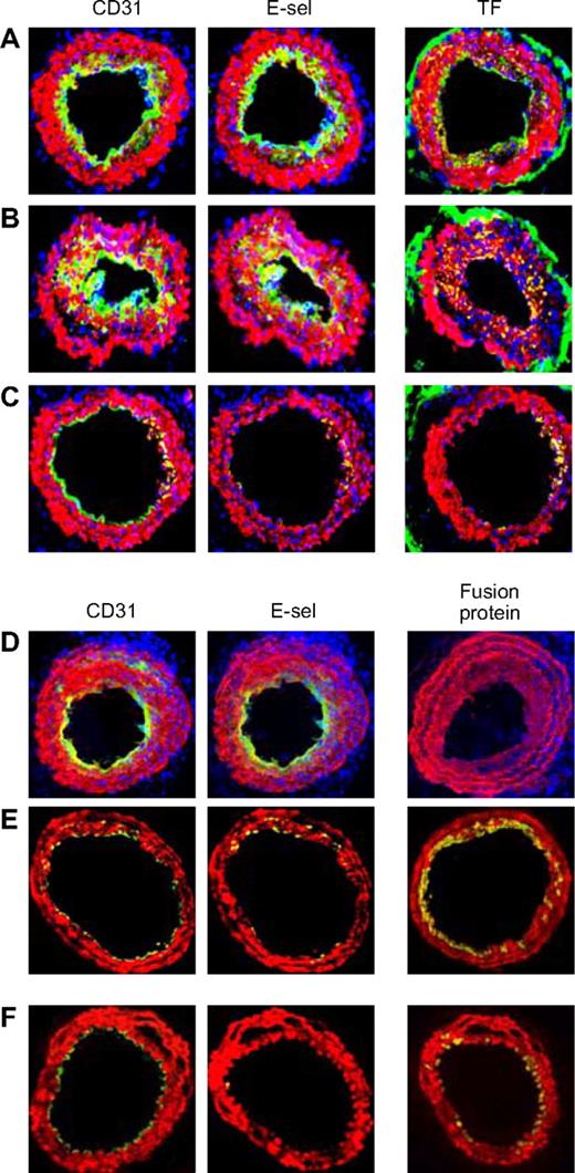 Figure 7. Effect of injected CD34+ cells on neointimal phenotype. CD34+ cells from WT mice were purified 2 days after wire injury, and incubated in vitro for 1 hour in either medium only (A) or with added thrombin (B) or PAR-1 and PAR-4 antagonists (C) before 7.5 × 105 cells were injected back into a second WT mouse immediately following wire injury. Alternatively, CD34+ cells were purified from WT (D), α-TFPI–Tg (E), or α-Hir–Tg mice (F) and injected immediately into a second injured mouse. (A-D) 3-color immunohistologic analysis of frozen sections from day 28 after injury. Sections were stained with DAPI (blue). (E,F) 2-color immunohistologic analysis. All sections stained with anti–α-SMA (red) and anti-CD31, anti–E-selectin, and either anti-TF or antifusion protein (green) as indicated. Yellow indicates colocalization. Original images taken at ×100 magnification. Repeated twice.