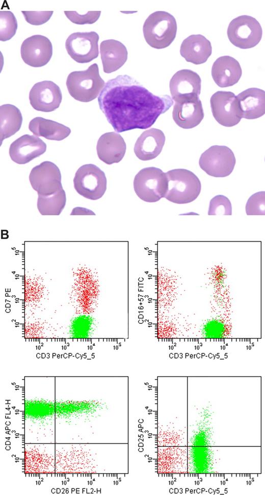 Figure 2. Sézary Syndrome. (A) Peripheral blood smear demonstrating an abnormal lymphoid cell with an irregular folded nucleus. Wright Giemsa stain, magnification ×100. Images were acquired as in Figure 1. (B) Representative flow cytometric dot plots with population of interest highlighted in green: CD3 versus CD7, demonstrating many CD7− CD3+ T cells; CD3 versus CD16 and/or CD57, demonstrating lack of NK-associated antigen expression; CD26 versus CD4, demonstrating many CD4+ cells, including more than 30% CD26− cells; and CD3 versus CD25, demonstrating only partial weak intensity staining of T cells for CD25.