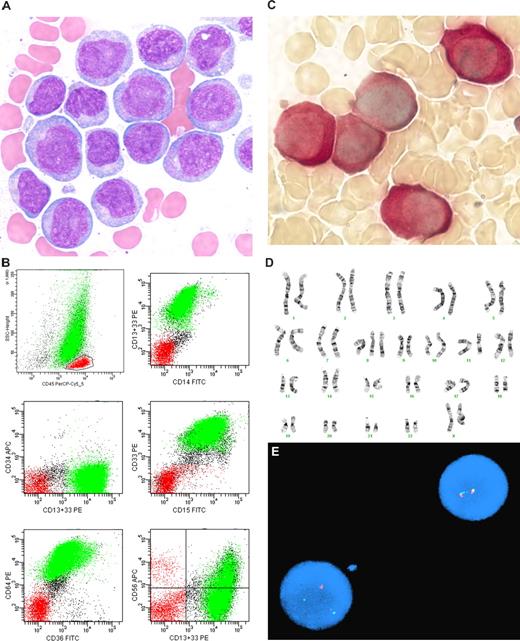 Figure 3. Acute myeloid leukemia with MLL rearrangement and monocytic differentiation. Although there is minimal staining with CD14, flow cytometric studies demonstrate other features associated with monocytic differentiation and a butyrate esterase cytochemical stain is positive. (A) Bone marrow aspirate smear demonstrating abnormal cells with moderately abundant cytoplasm, a few cytoplasmic granules, and some irregularity in nuclear outlines. Wright Giemsa stain, magnification ×100. (B) Representative flow cytometric dot plots: CD45 versus side scatter demonstrates a small population of lymphoid cells indicated in red, and a population of interest highlighted in green with weak intensity CD45 and variable side (orthogonal) light scatter; CD14 versus CD13+33 demonstrates staining for the myeloid antigens CD13 and/or CD33 and minimal staining for CD14; CD13+33 versus CD34 demonstrates absence of staining for CD34; CD15 versus CD33 demonstrates relatively bright staining for CD33 and variable intensity staining for CD15; CD36 versus CD64 demonstrates staining for both CD36 and CD64; and CD13+33 versus CD56 demonstrates partial aberrant expression of CD56. (C) Butyrate esterase cytochemical stain demonstrating many positive cells; magnification ×100. Staining was inhibited with fluoride incubation (not shown). (D) Classical cytogenetic studies demonstrating 47,XX,+8,t(11,19)(q23;p13.3). Courtesy of the Pittsburgh Cytogenetics Laboratory, Magee-Womens Hospital, Pittsburgh, PA. (E) FISH studies demonstrating an MLL gene rearrangement. Hybridization with the LSI MLL dual color DNA probe demonstrates one cell (lower left) with one fusion signal (corresponding to the unrearranged chromosome 11 at band 11q23) and separate green and red signals corresponding to the split MLL gene, and one normal cell (top right) with 2 fusion signals. Courtesy of the Pittsburgh Cytogenetics Laboratory, Magee-Womens Hospital, Pittsburgh, PA. Images were acquired as in Figure 1.