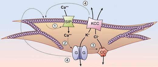 Transport pathways contributing to sickle cell dehydration. Hemoglobin (Hb) S polymerization activates the sickling-induced pathway, permitting Ca++ entry. Increased cytoplasmic Ca++ activates the Gardos pathway, which mediates rapid K+ efflux, balanced by Cl− exit via a chloride conductance pathway. High Hb S concentration resulting from abnormal regulation of K:Cl cotransport may potentiate Hb S polymerization in reticulocytes. Once initiated, the vicious cycle of sickling and dehydration intensifies and perpetuates itself. KCC indicates K:Cl cotransporter; SIP, sickling-induced pathway; G, Gardos pathway; and CC, Cl conductance pathway.