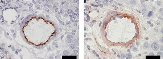Figure 2. Coexpression of CD31 and lactadherin in tumor vasculature. (A) Immunohistochemical staining for panendothelial cell marker CD31 in a B16.F10 melanoma tissue section. Scale bar represents 20 μm. (B) Immunohistochemical staining for lactadherin in a sequential B16.F10 melanoma tissue section. Scale bar represents 20 μm.