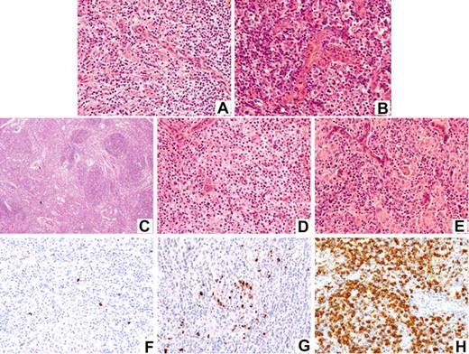 Figure 1. Histopathologic spectrum of AITL and patterns of CXCL13 expression. Panels A-E illustrate the large spectrum of angioimmunoblastic lymphoma. Panels F,G illustrate CXCL13 immunostaining patterns: (A) classic-type, (B) rich in large cells, (C) with hyperplastic germinal centers, (D) rich in clear cells, (E) rich in epithelioid cells (hematoxylin eosin stain); (F) score 1, (G) score 2, and (H) score 3. Images were captured by a Zeiss microscope (Carl Zeiss, Heidelberg, Germany); original magnifications ×25 (C) and ×250 (A,B,D-H). The different morphologic subtypes and the level of CXCL13 expression did not influence survival.
