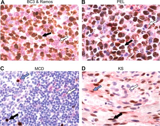 Figure 5. KSHV-positive cells in primary cases of PEL, KS, and MCD exhibit decreased levels of TβRII. (A) Double immunohistochemical staining for TβRII and LANA in a cell clot containing a 1:1 mixture of BC3 cells (black arrow) and Ramos cells (white arrow), (B) a primary PEL specimen cell clot containing neoplastic (black arrow) and reactive (white arrow) cells, (C) a MCD tissue section, and (D) a KS tissue section. LANA positivity appears as brown nuclear staining and TβRII appears red at the membrane and in the cytoplasm. Black arrows indicate LANA+, TβRII− cell; white arrow, LANA−, TβRII+ cell; blue arrow, LANA+, TβRII+ cell (original magnification ×132)