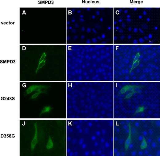 Figure 4. Subcellular localization of wild-type and mutant SMPD3 in MDCK cells. Tagged version of wild-type and mutant SMPD3 (G247S and D358G) were transfected, and their subcellular localization was determined by indirect fluorescence microscopy. More than 70% of stained cells within each sample showed similar staining as depicted in the panels. Magnification: 20×/0.75 NA Plan Apo objective of samples in Vectashield mounting medium for dluorescence with DAPI, H-1200 (Vector Laboratories, Burlingame, CA) stained with Alexa Fluor 488 goat antimouse IgG H+L (Invitrogen). Images were acquired using a Retiga 200R digital camera (QImaging, Surrey, BC) and HIS-Elements Ar 2.30 software (Nikon) and processed using Adobe Photoshop 7.0 (Adobe Systems, San Jose, CA).