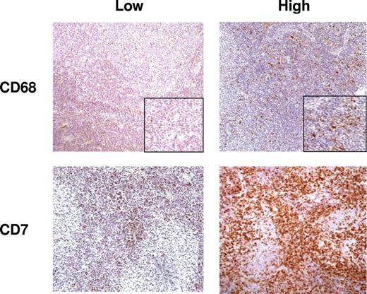 Figure 1. Representative sections from cases with low and high numbers of cells positive for CD7 and CD68; immunohistochemistry DAB staining (200×).
